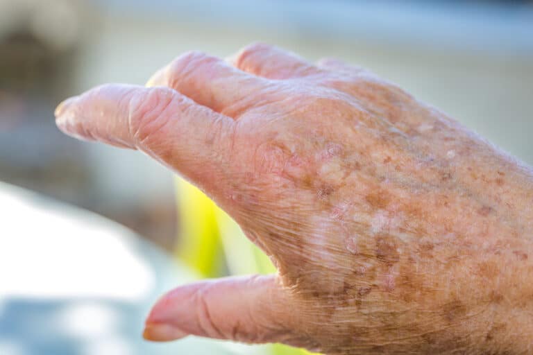 Elderly Care in Pacific Beach CA: What is Eczema